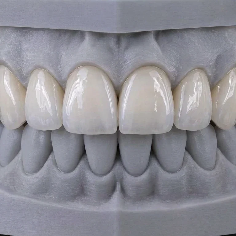 Mehr über hauchdünne Veneers für ein strahlendes Lächeln lesen. Hauchdünne Keramik-Veneers für eine ästhetische Korrektur der Frontzähne.