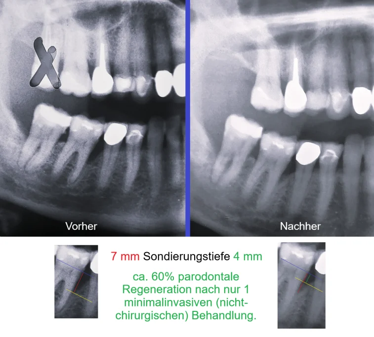 Parodontitis Augsburg - Erfolgreiche Behandlung und moderne antiinfektiöse Therapie für parodontale Regeneration Behandlungserfolg der parodontitis Behandlung und parodontale Regeneration.