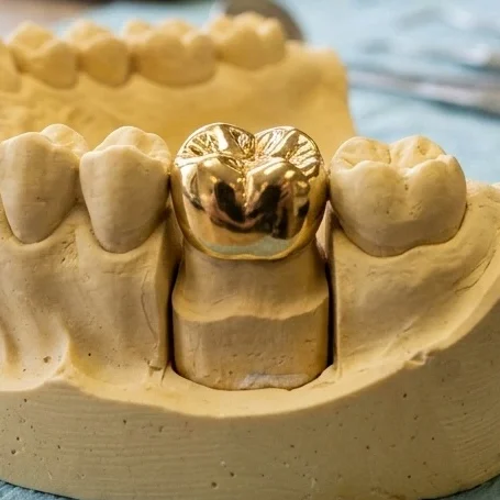 Mehr über hochgoldhaltigen Zahnersatz erfahren. Hochwertige Goldkronen und Brücken auch für Allergiker in der Zahnarztpraxis Semmler in Augsburg.
