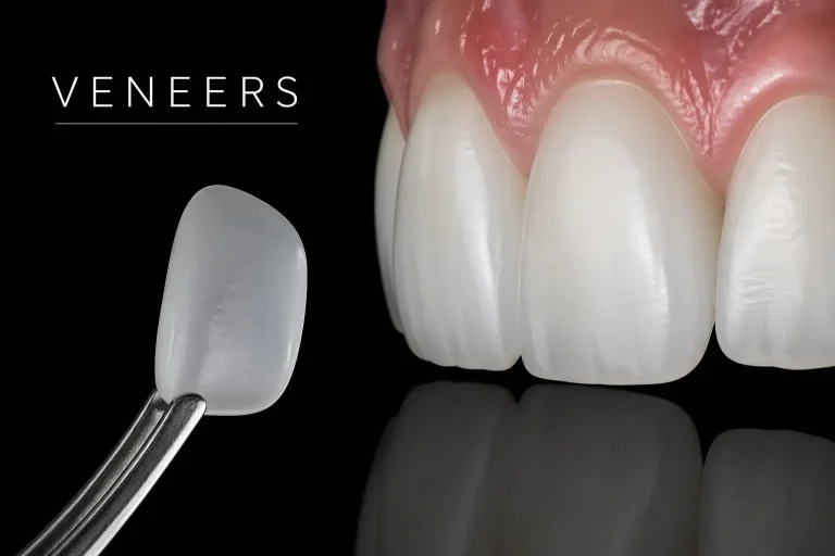 Veneers aus Keramik in Augsburg beim Zahnarzt für sehr hohe Ästhetik. Veneers aus Keramik in Augsburg beim Zahnarzt für sehr hohe Ästhetik.